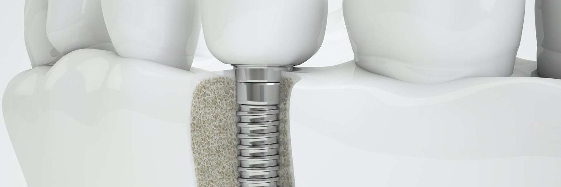 dental implants surf city 