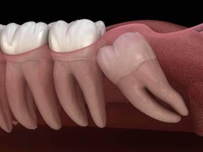 wisdom teeth removal surf city