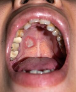 mouth sore
