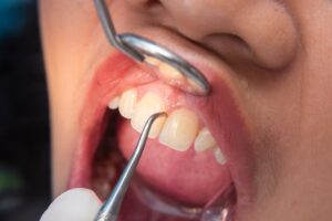 close up view of scaling on teeth