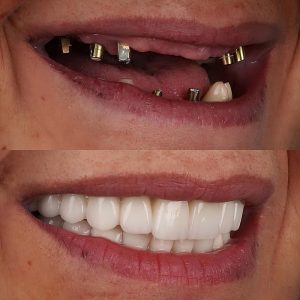 before and after dental implants